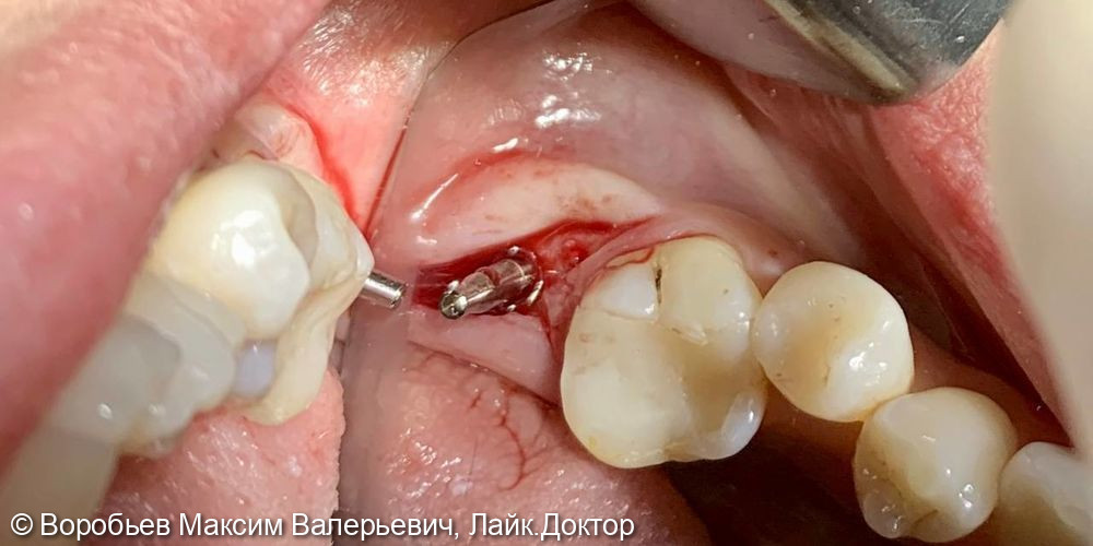 имплантация в области 37 го зуба - фото №3