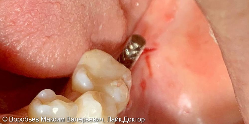 имплантация в области 37 го зуба - фото №6