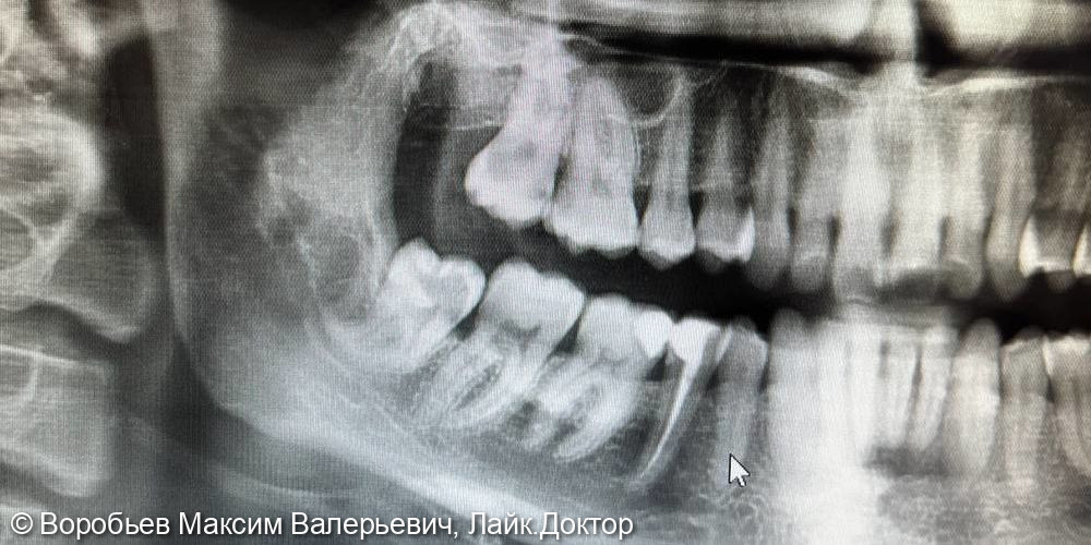 удаление полуретинированного зуба 48 - фото №1