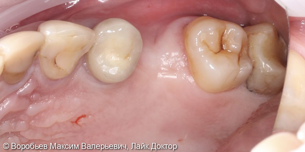 Открытый синус лифтинг в проекции отсутствующего зуба на верхней челюсти справа перед последующей имплантацией - фото №1