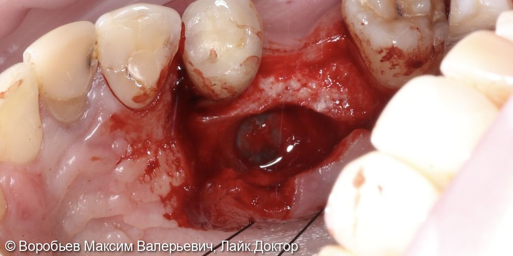 Открытый синус лифтинг в проекции отсутствующего зуба на верхней челюсти справа перед последующей имплантацией - фото №3