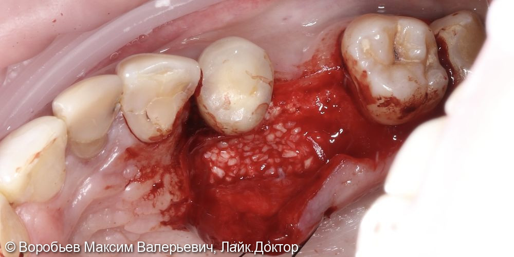 Открытый синус лифтинг в проекции отсутствующего зуба на верхней челюсти справа перед последующей имплантацией - фото №4