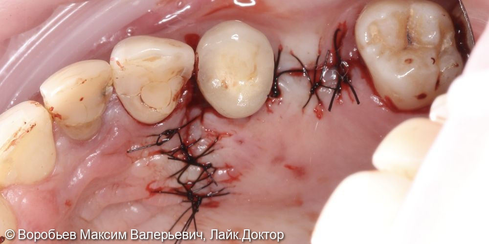 Открытый синус лифтинг в проекции отсутствующего зуба на верхней челюсти справа перед последующей имплантацией - фото №5