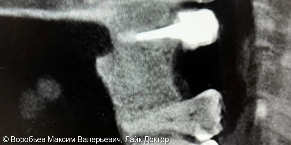 Открытый синус лифтинг в проекции отсутствующего зуба на верхней челюсти справа перед последующей имплантацией - фото №6