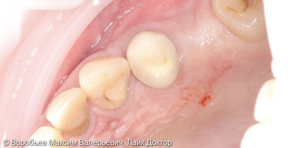 Открытый синус лифтинг в проекции отсутствующего зуба на верхней челюсти справа перед последующей имплантацией - фото №7