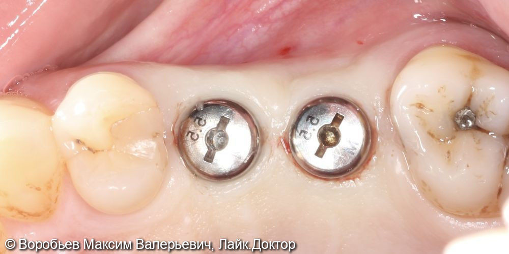 Имплантация в проекции зубов 15,16 - фото №8