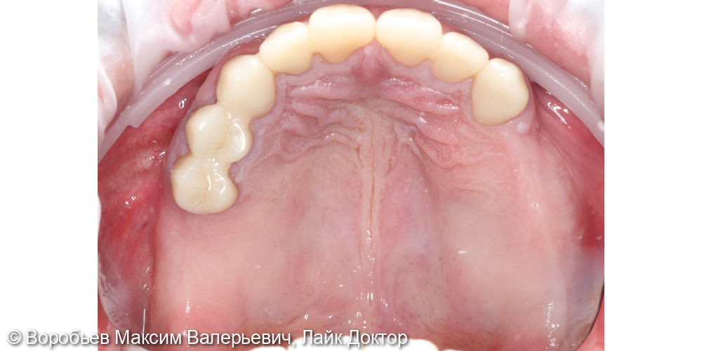 Имплантация отсутствующих зубов - фото №1