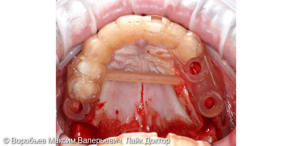 Имплантация отсутствующих зубов - фото №2