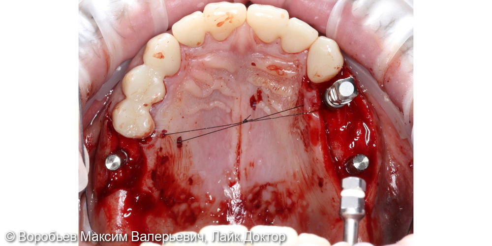 Имплантация отсутствующих зубов - фото №3