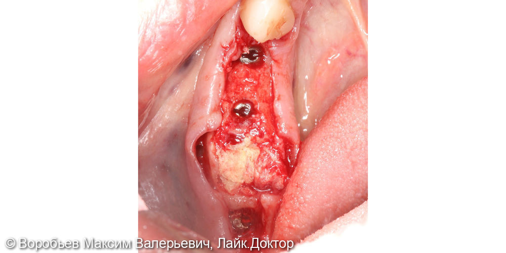 Имплантация, удаление зуба - фото №2
