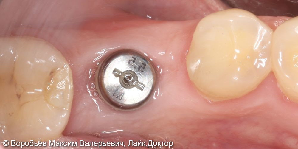 Имплантация одномоментная 46 зуба - фото №5