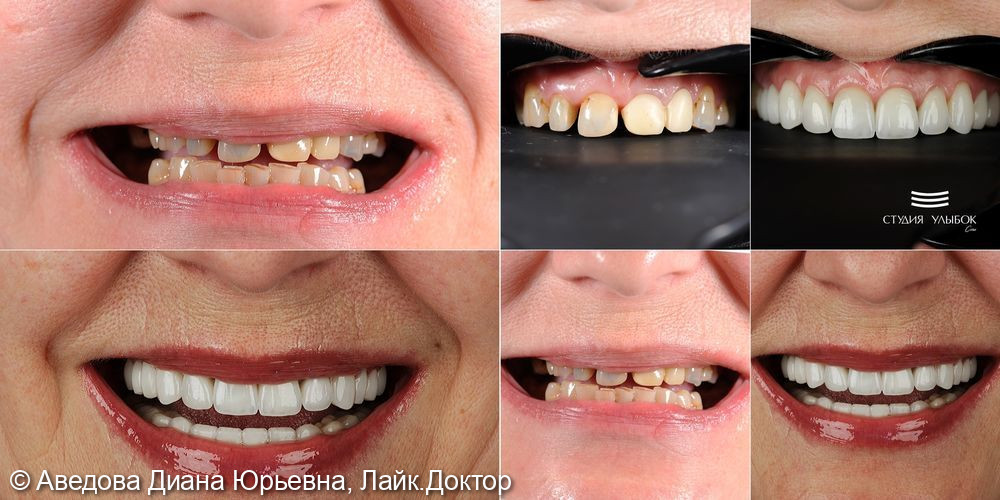 Результат комплексного протезирования и имплантации зубов - фото №1