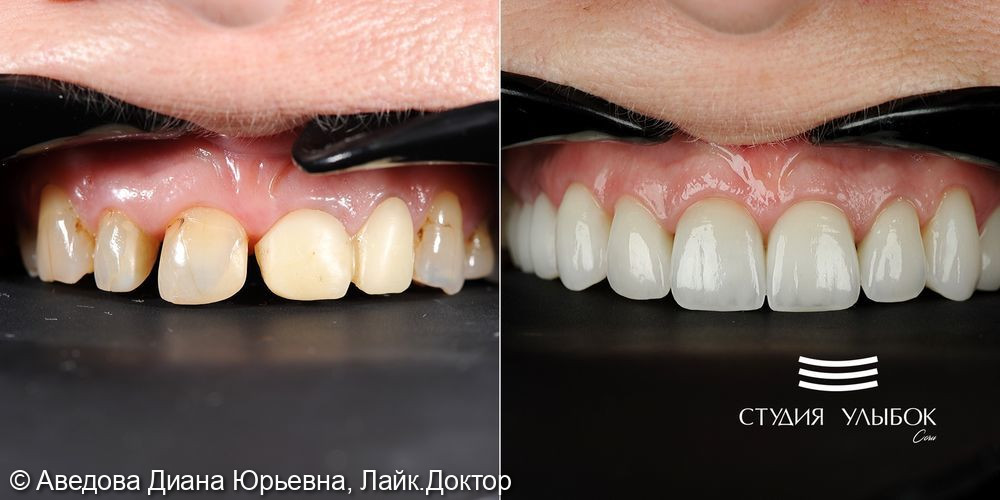 Результат комплексного протезирования и имплантации зубов - фото №2