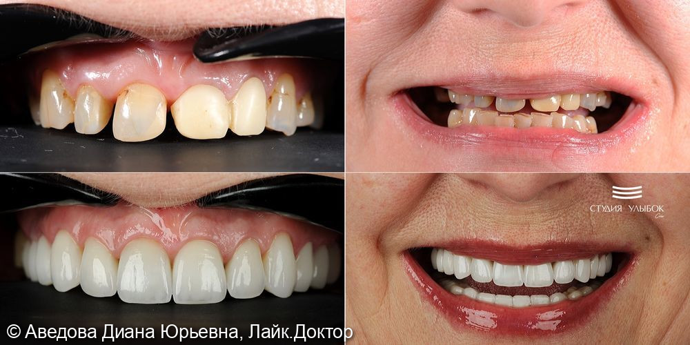 Результат комплексного протезирования и имплантации зубов - фото №3