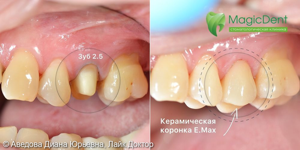 Установка керамической коронки E.Max на зуб 2.5 после эндодонтического лечения каналов - фото №1