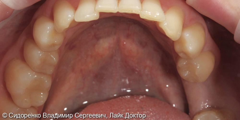 Имплантация жевательного зуба - фото №1
