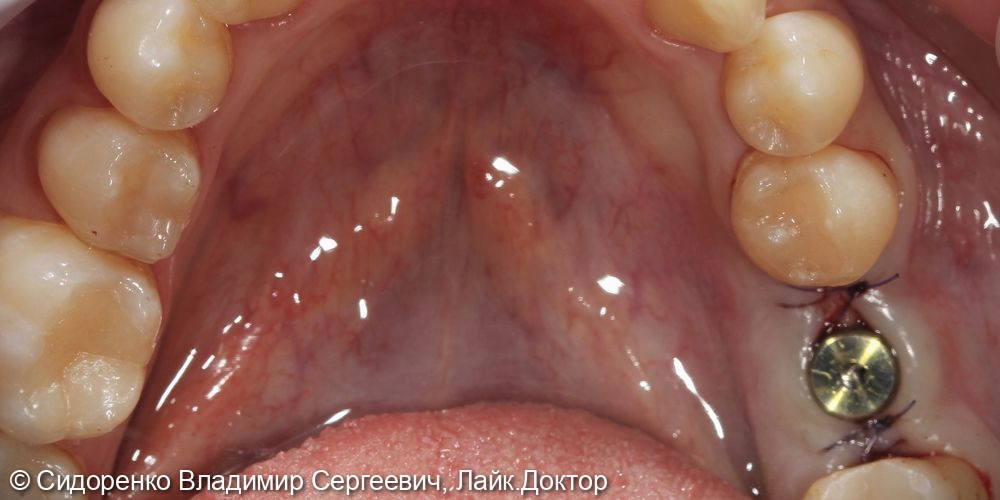 Имплантация жевательного зуба - фото №2