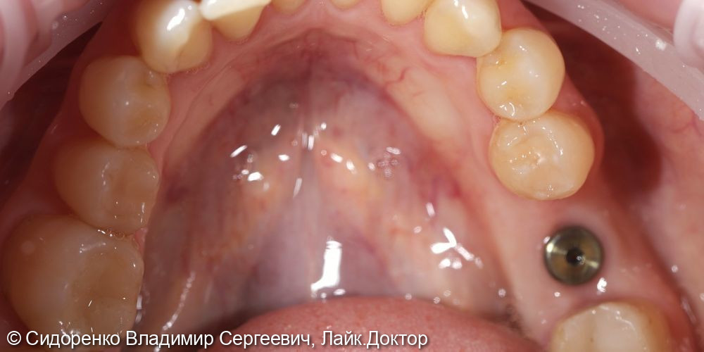 Имплантация жевательного зуба - фото №3