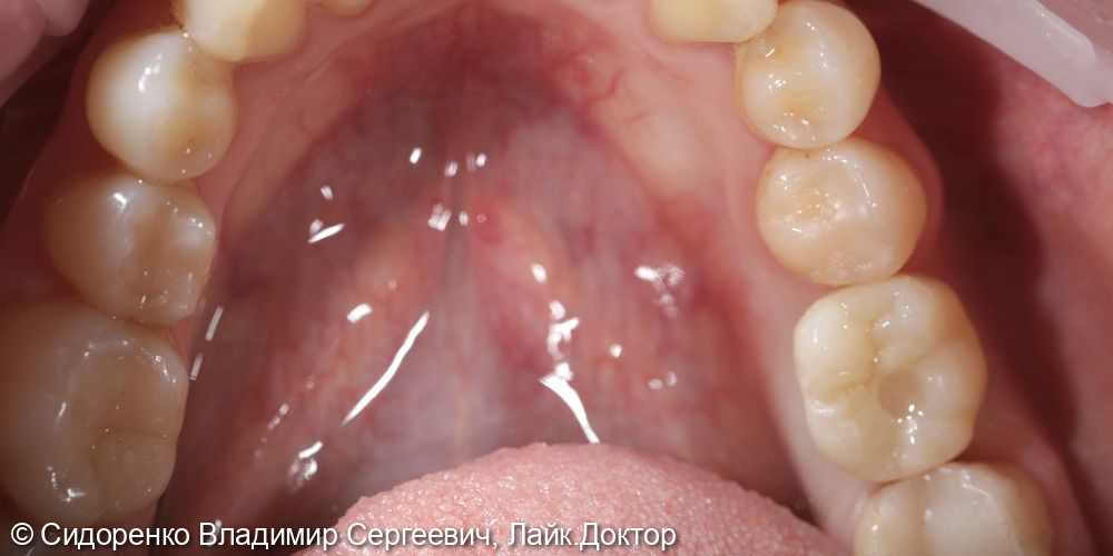 Имплантация жевательного зуба - фото №4