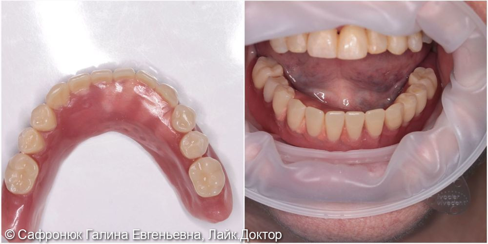 Восстановление зубов на нижней челюсти - фото №1