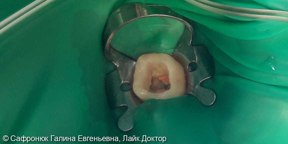 Восстановление коронковой части зуба керамической вкладкой E.max - фото №1