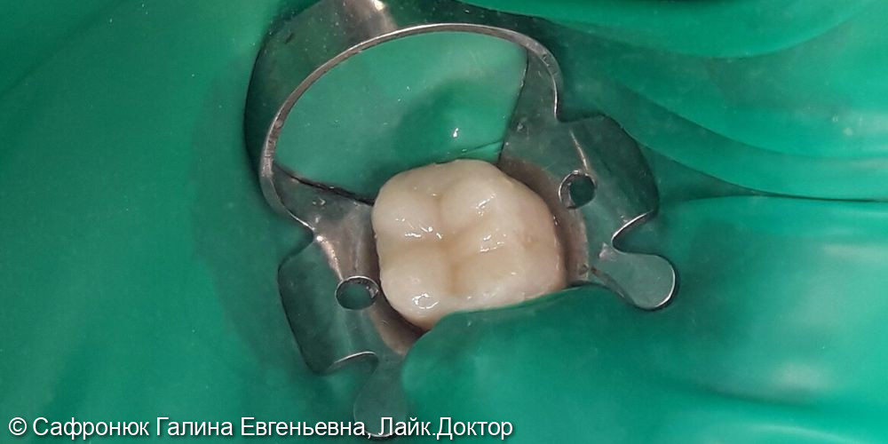 Восстановление коронковой части зуба керамической вкладкой E.max - фото №2