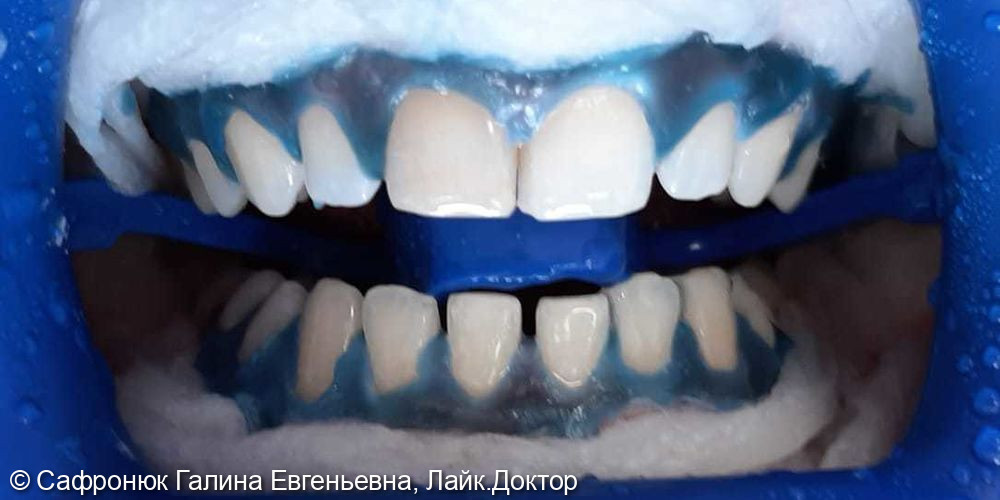 Отбеливание зубов системой ZOOM и замепа пломбы на зубе 1.1 - фото №1