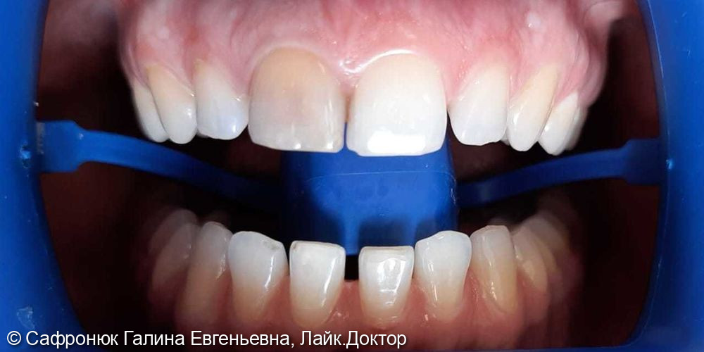 Отбеливание зубов системой ZOOM и замепа пломбы на зубе 1.1 - фото №2