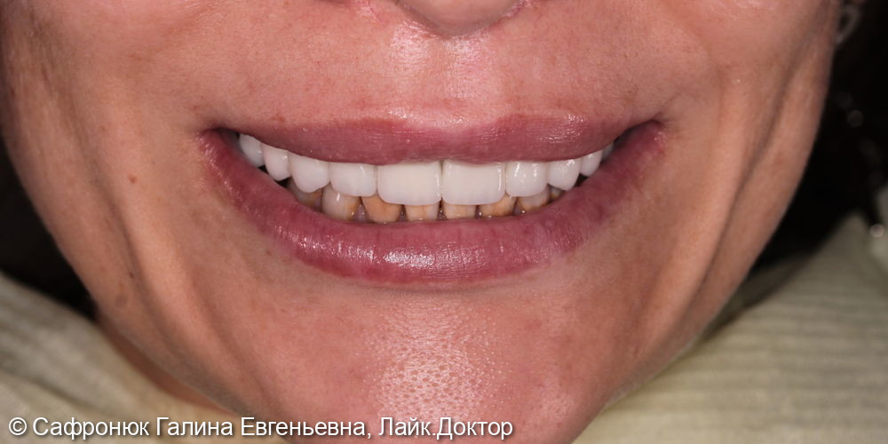 Реставрация фронтальной группы зубов верхней челюсти керамическими винирами - фото №1