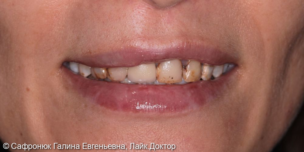 Реставрация фронтальной группы зубов верхней челюсти керамическими винирами - фото №2