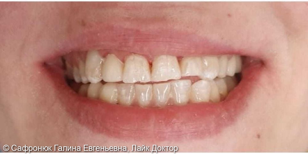 Реставрация зубов светоотверждаемым композитом - фото №2
