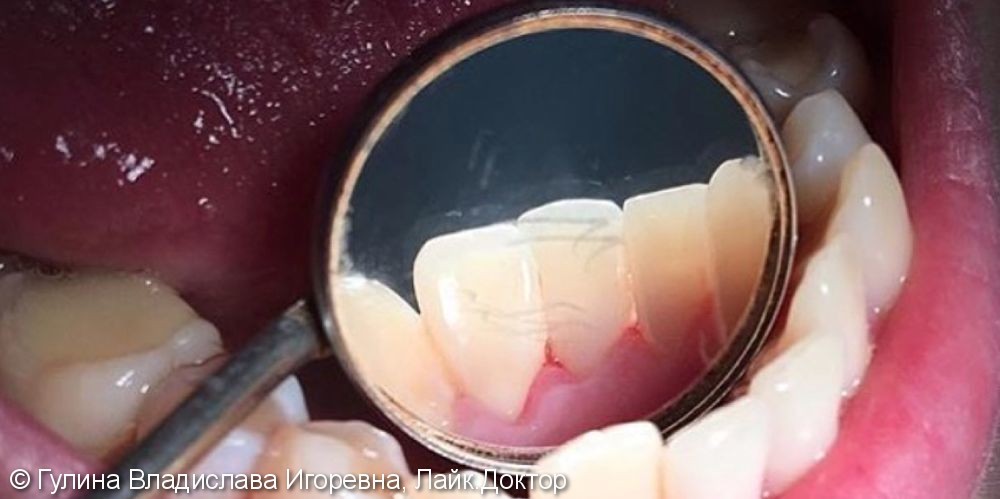 Жалобы на кровоточивость десен во время чистки зубов, пигментированный налет на зубах - фото №2