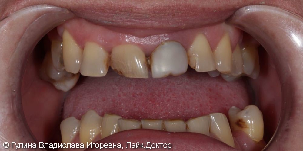 4 керамических винира Имакс на передние зубы, до и после - фото №1