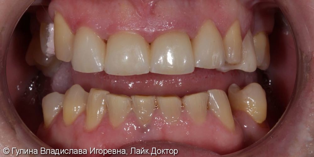 4 керамических винира Имакс на передние зубы, до и после - фото №2