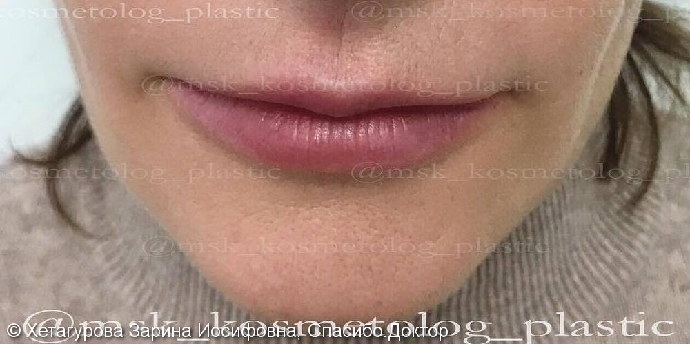 Фото до/после: опущение уголков губ, недостаток объёма губ, асимметрия, нечёткий контур - фото №1