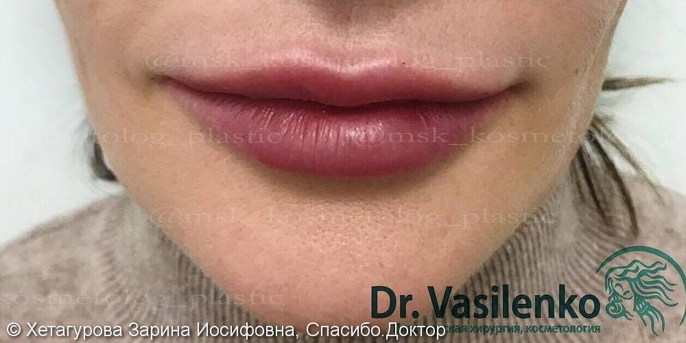 Фото до/после: опущение уголков губ, недостаток объёма губ, асимметрия, нечёткий контур - фото №2