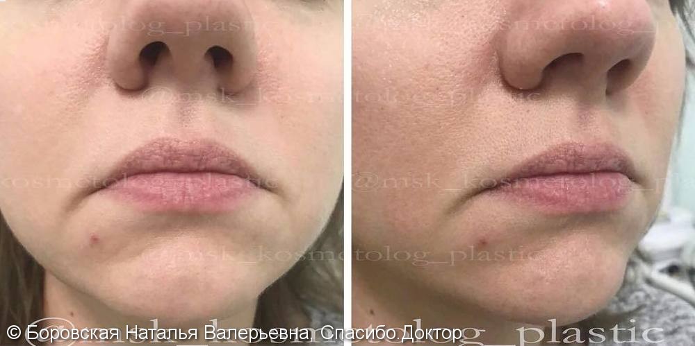 Фото до и после исправления опущенных уголков губ, пластика губ - фото №1