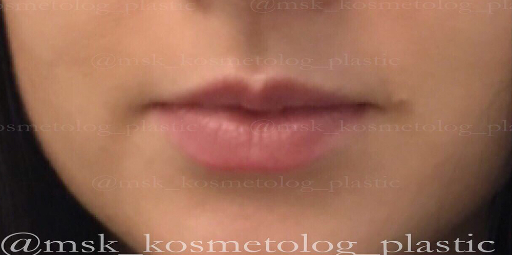 Придать объем верхней губе, чтобы она стала больше по отношению к нижней - фото №1