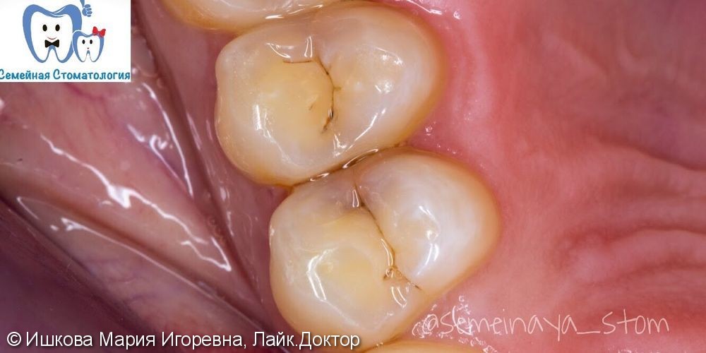 Лечение кариеса 25 зуба - фото №1