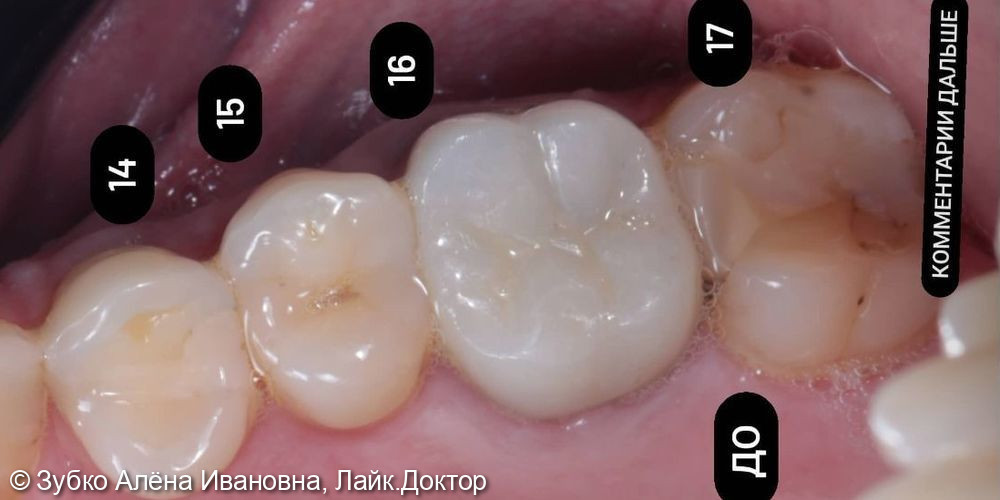 Лечение кариеса 15 и 17 зубов - фото №1