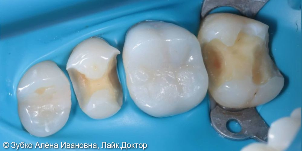 Лечение кариеса 15 и 17 зубов - фото №2