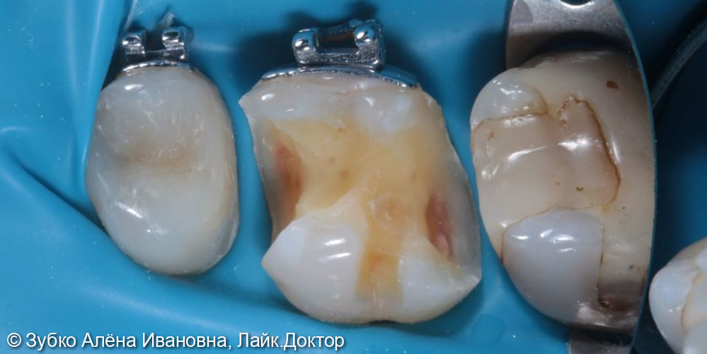 Лечение глубокого кариеса 16 зуба - фото №1