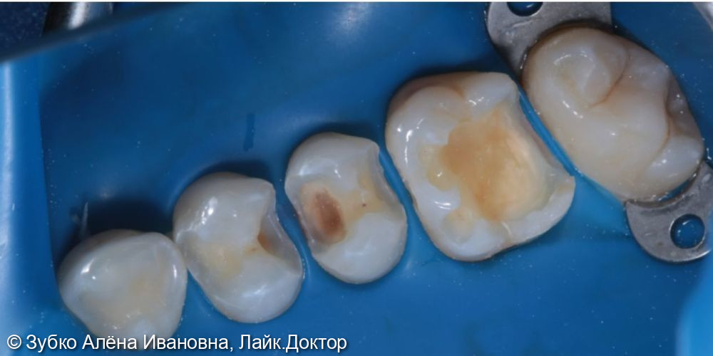Лечение кариеса 14 15 16 зубов - фото №2