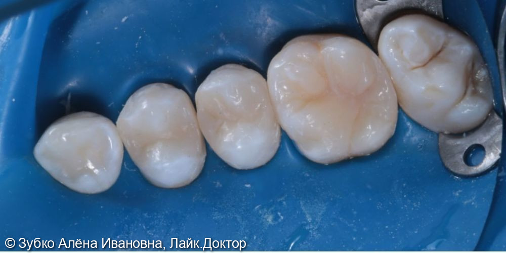 Лечение кариеса 14 15 16 зубов - фото №3