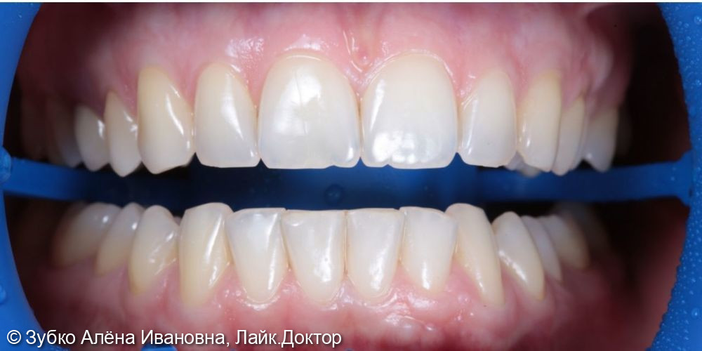 Отбеливание зубов ZOOM 4 - фото №1