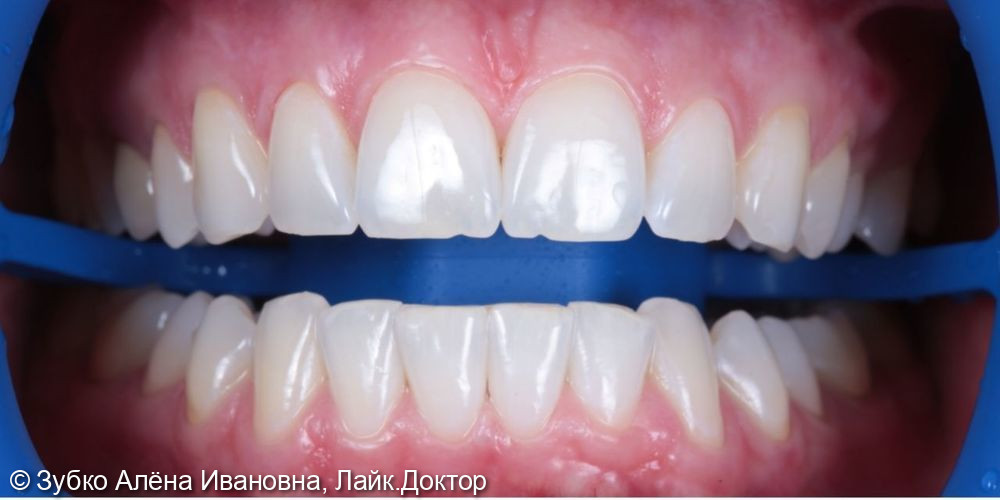 Отбеливание зубов ZOOM 4 - фото №2