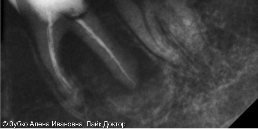 Лечение хронического апикальнрго периодонтита 36 зуба - фото №1