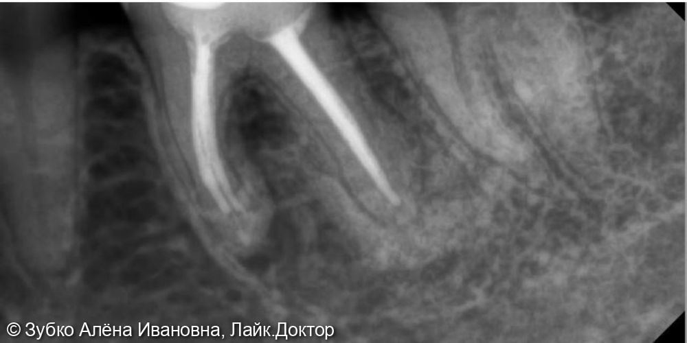 Лечение хронического апикальнрго периодонтита 36 зуба - фото №2