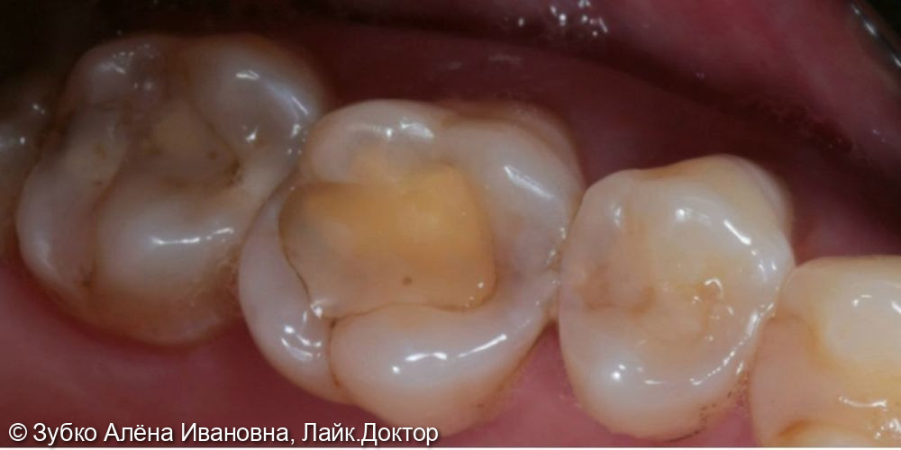 Лечение глубоко кариеса 26 27 зубов - фото №1