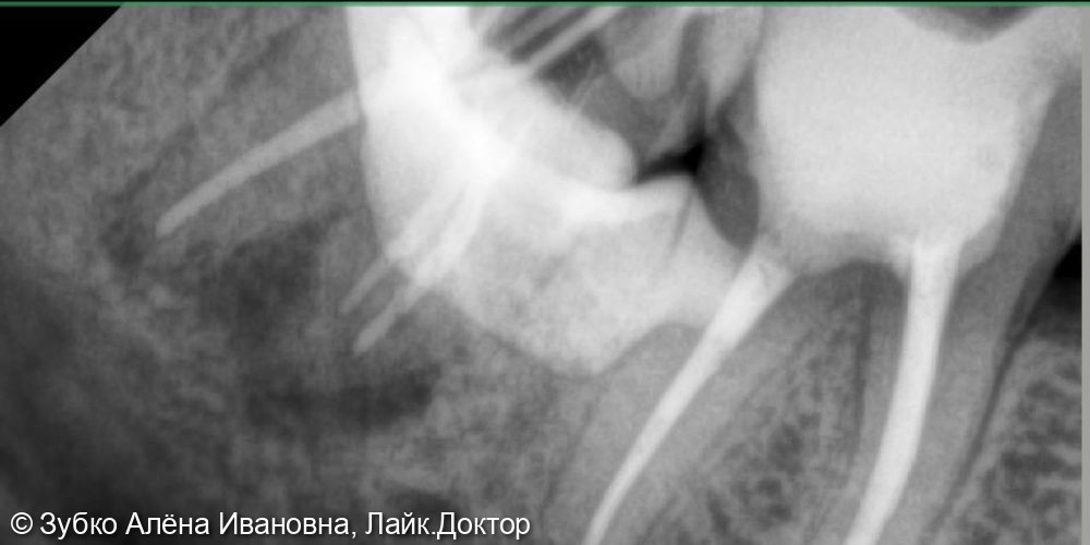 Лечение хронического апикальнрго периодонтита 48 зуба - фото №1